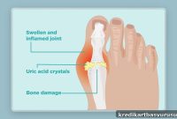 My First Acute Gout Attack: Symptoms, Treatment, and Recovery Tips
